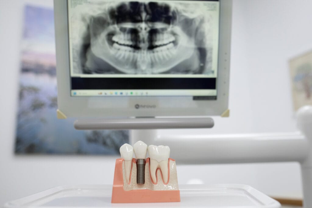 Dental implants at Richmond Road Dental